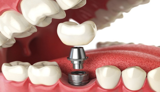 İmplant Diş Nedir?