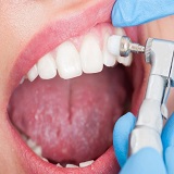 Diş Taşı Temizliği